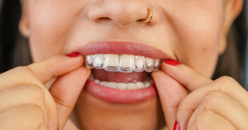 Invisalign Aligner