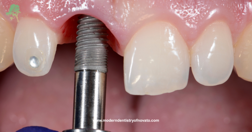 Dental Impant Repair