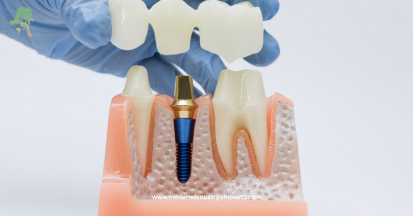 Fixed Implant Bridges