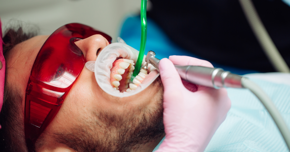 Deep Teeth Cleaning