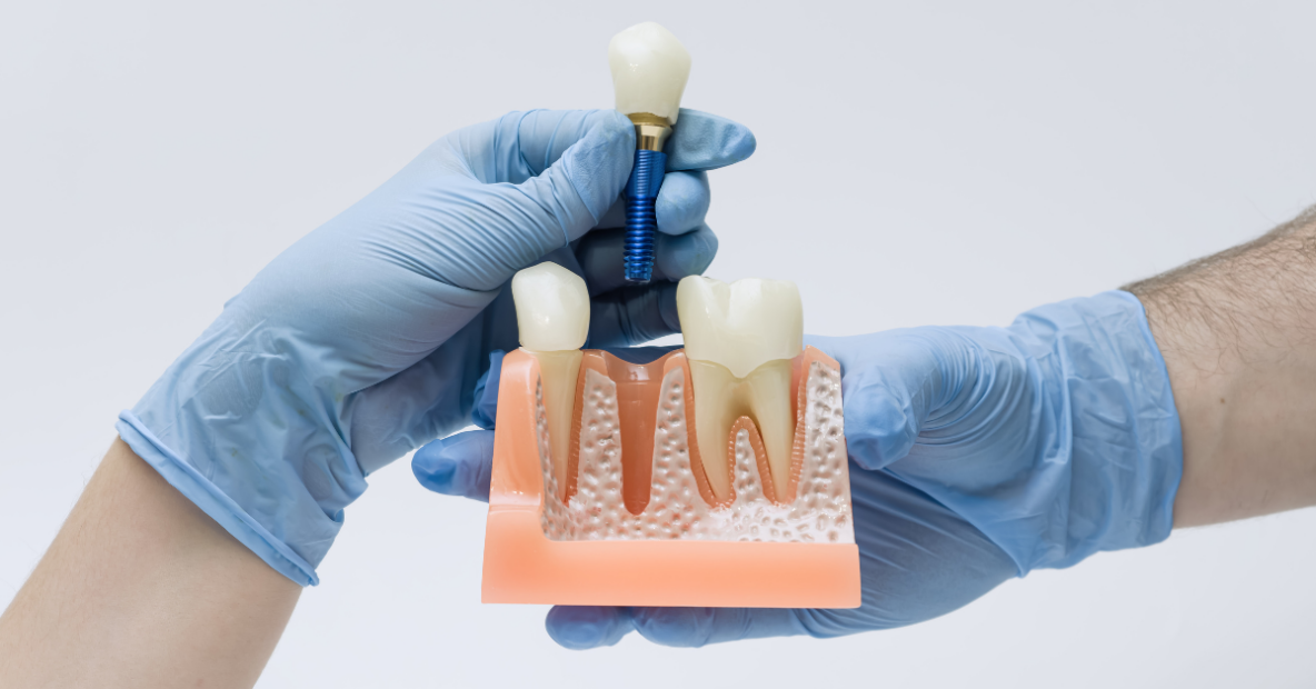 single tooth replacement options​