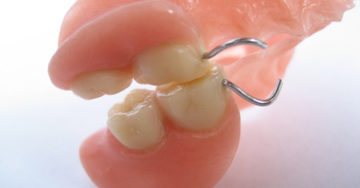 single tooth replacement options