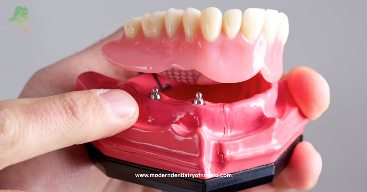 Implant Hybrid Dentures