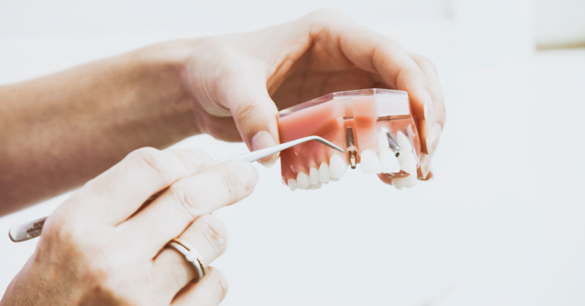 Fixed Bridge Dental Implants
