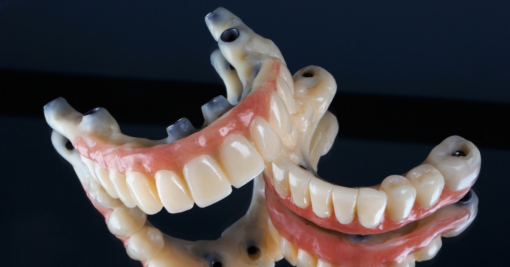 Full Mouth Dental Implants