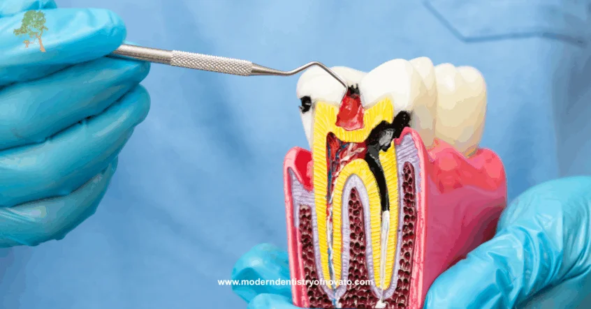 Root canal