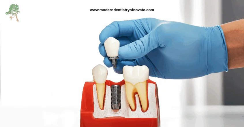 Dental implants