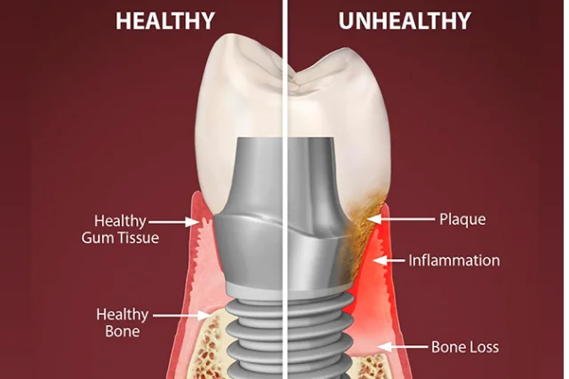 Dental Implant Maintenance