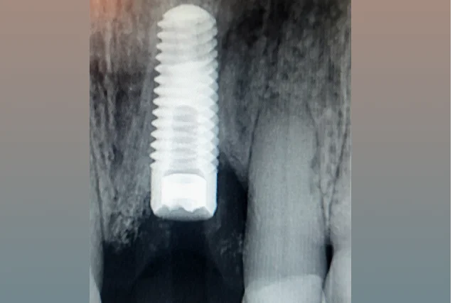 Dental Implant Repair