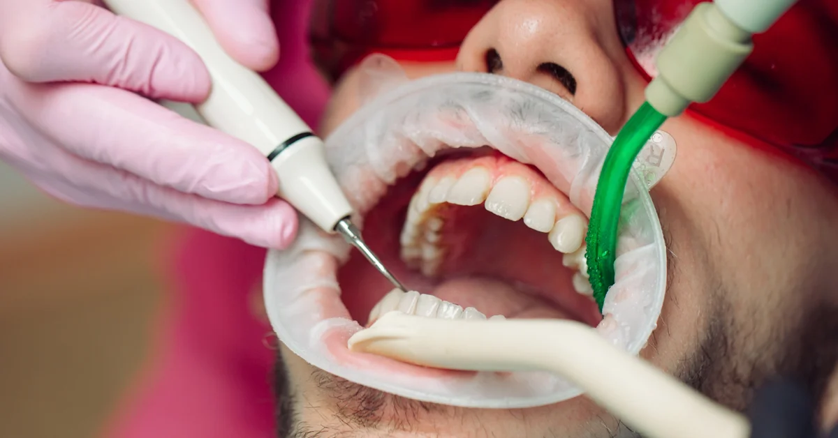 Deep Teeth Cleaning