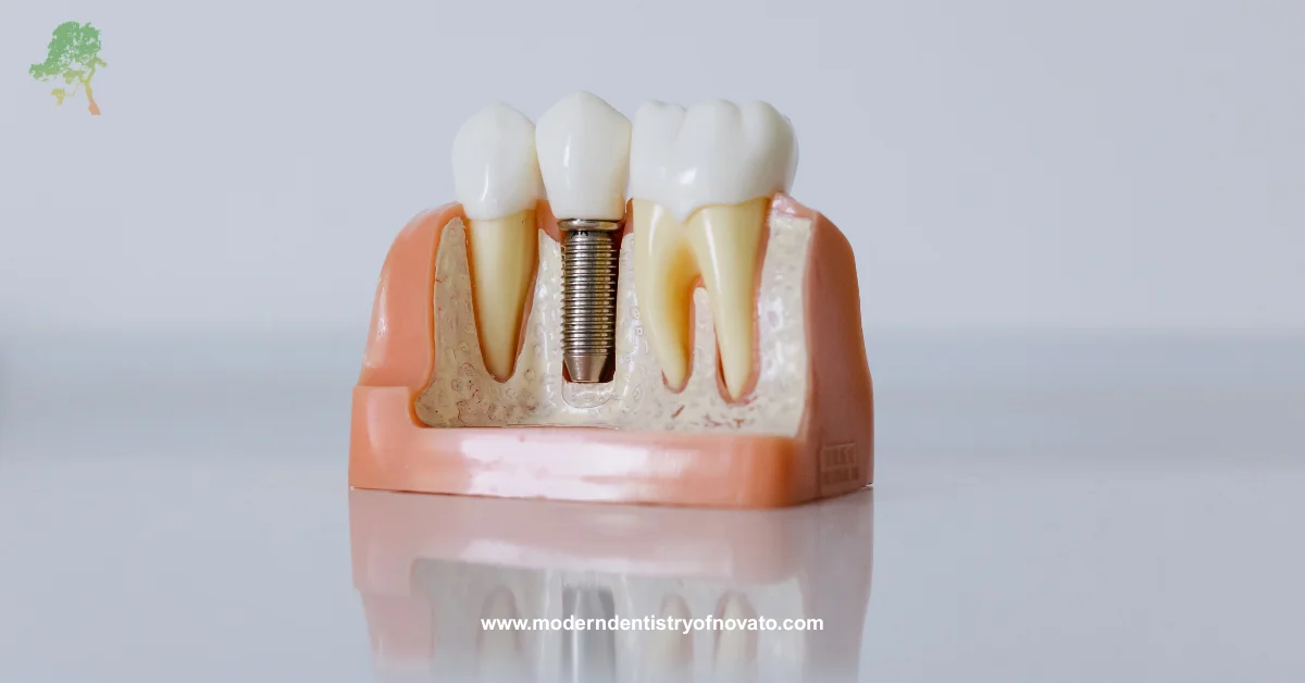 Dental Implant
